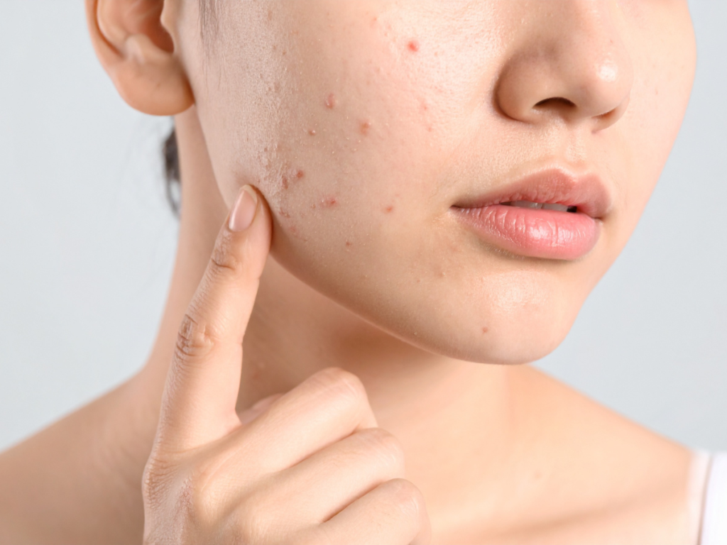 acne tarda Trądzik po 30 roku życia
